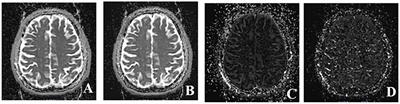 Non-Invasive Evaluation of Cerebral Hemodynamic Changes After Surgery in Adult Patients With Moyamoya Using 2D Phase-Contrast and Intravoxel Incoherent Motion MRI